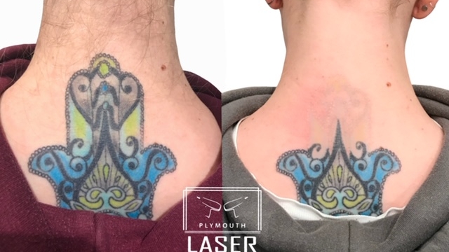 Cost Of Tattoo Removal – Options Depending On Budget