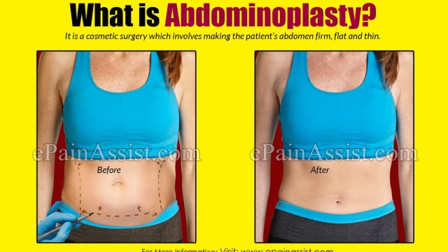 Flatten Your Tummy: Unveiling the Wonders of Abdominoplasty