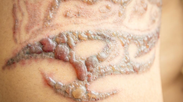 The Pluses And Minuses Of Laser Tattoo Removal