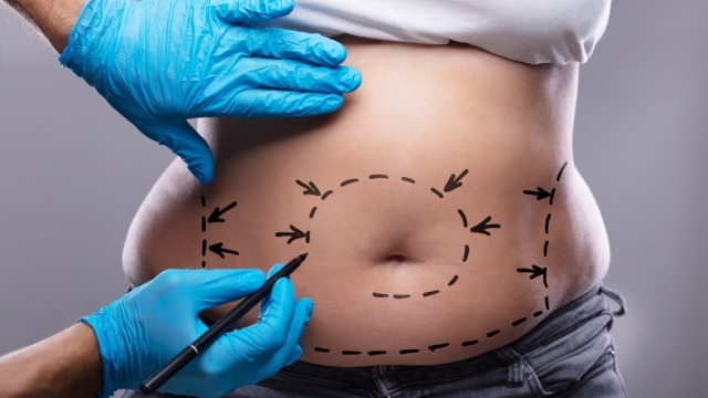 Tummy Tuck Transformation: The Incredible Benefits of Abdominoplasty