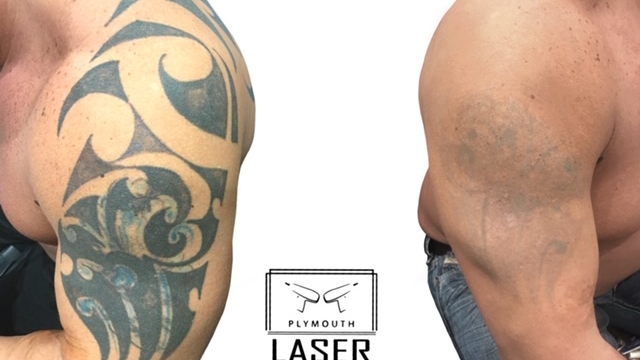 5 Approaches To Tattoo Ink Removal