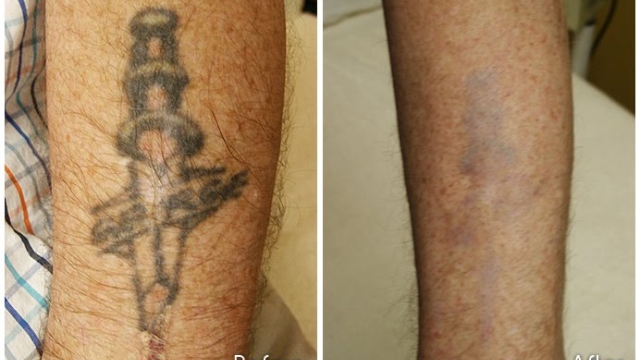 The Costly Tattoo Removal