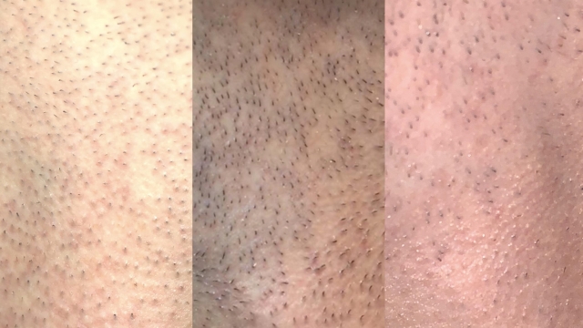 The Ultimate Guide to Effortless Hair-Free Skin: Laser Hair Removal 101